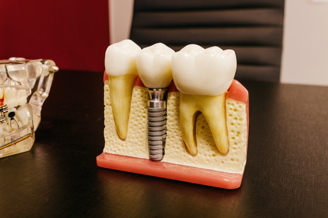 An Example of Dental Implants | Klamath Smiles Dentist